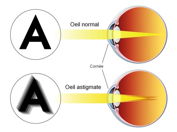 Explication de l'astigmatisme