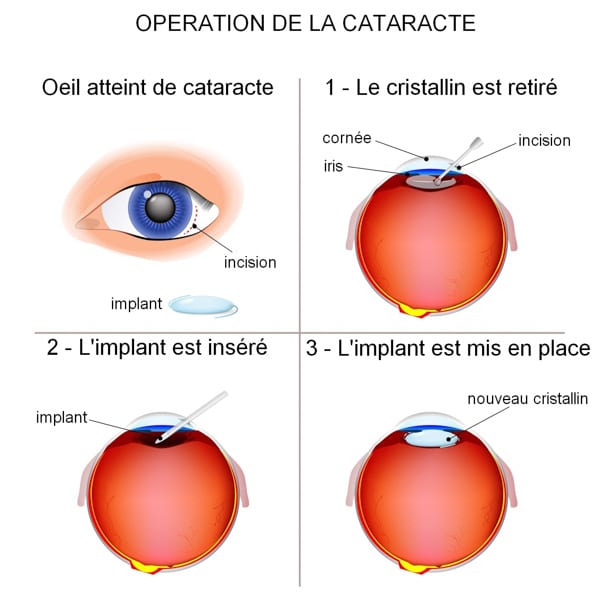La chirurgie de la cataracte Centre ophtalmologie eVision