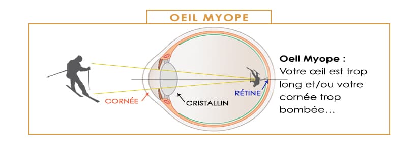 les défauts de la vision et la correction laser oeil myope la myopie