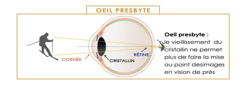les défauts de la vision et la correction laser oeil PRESBYTE PRESBYTIE