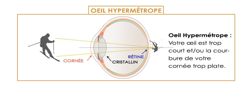 les défauts de la vision et la correction laser oeil hypermétrope hypermétropie